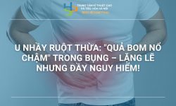 U NHẦY RUỘT THỪA: NGUYÊN NHÂN, TRIỆU CHỨNG VÀ CÁCH ĐIỀU TRỊ